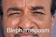 Blepharospasm