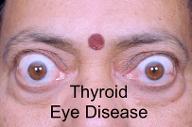 Thyroid Eye Disease